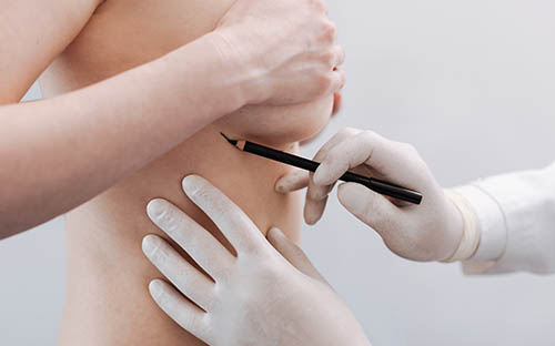 Breast Reconstruction