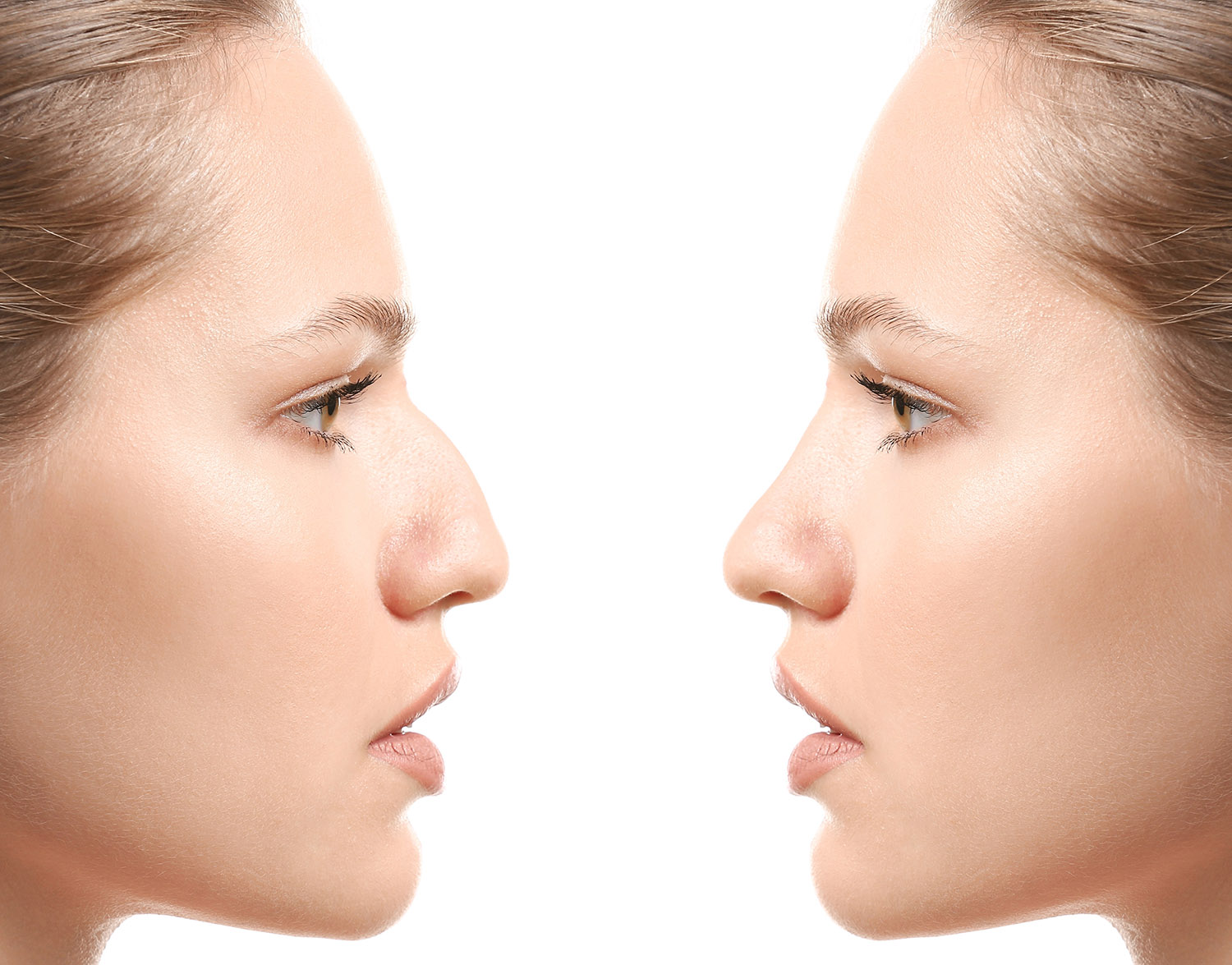 Rhinoplasty